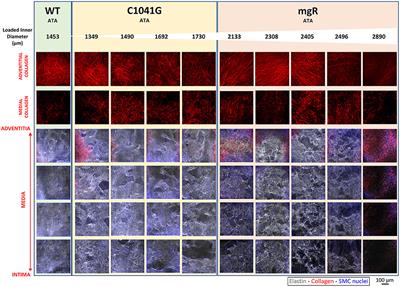 Progressive Microstructural Deterioration Dictates Evolving Biomechanical Dysfunction in the Marfan Aorta